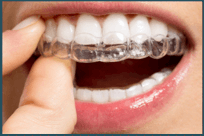 Mersin Diş Sıkma ve Gıcırdatma Tedavisi