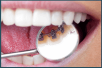 Mersin Lingual Ortodonti